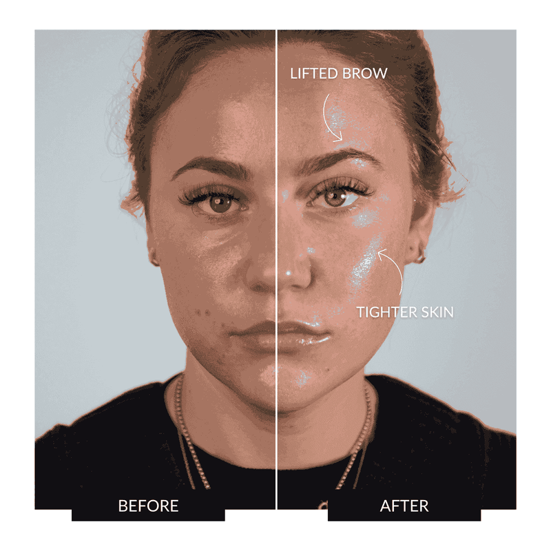 Before and After Archives - Facial Flex