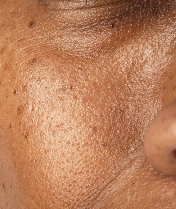 Hyperpigmentation