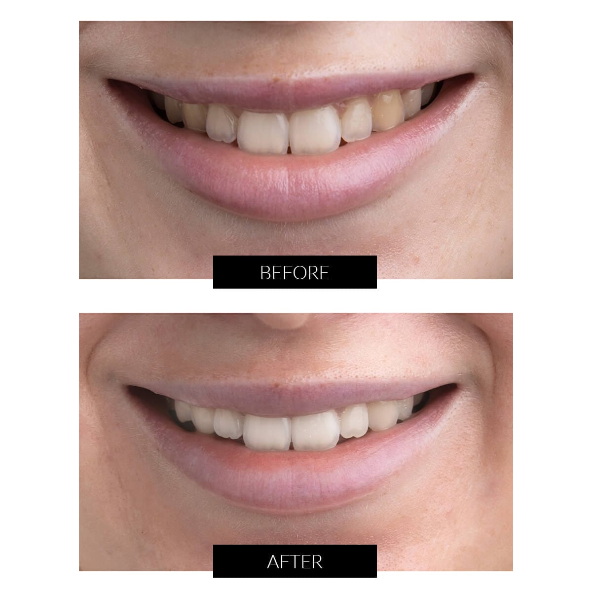 CurrentBody Skin Teeth Whitening Gel Refill Syringes (5ml)